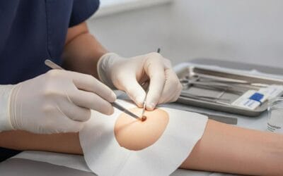 Kiedy najlepiej sprawdzają się klasyczne metody usuwania pieprzyków Kiedy najlepiej sprawdzają się klasyczne metody usuwania pieprzyków