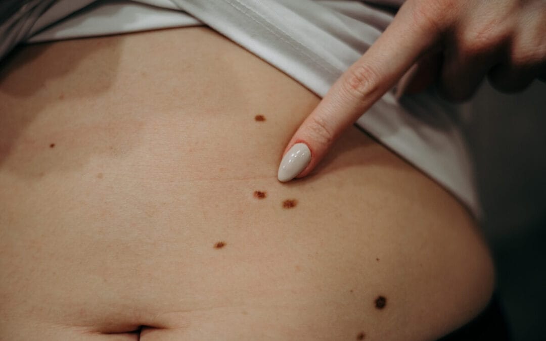 Kiedy usuwanie pieprzyków jest konieczne dla Twojego zdrowia?